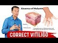 Fix Vitiligo With Copper