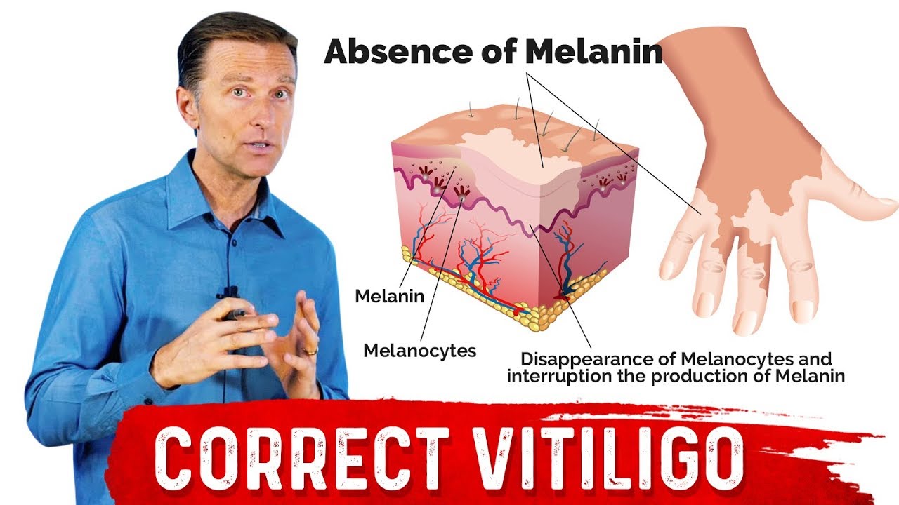Fix Vitiligo With Copper Youtube