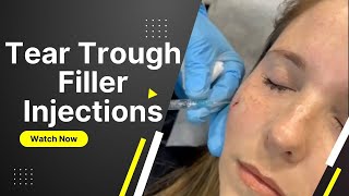 Tear Trough Filler Injection Technique By Dr. Dahabra | Best Botox Services At West Palm Beach