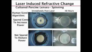 #Presbyopia Foundations of the #LENSAR Laser System