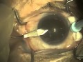 Cataract Surgery (Part 1 of 4) | Dr. David Richardson