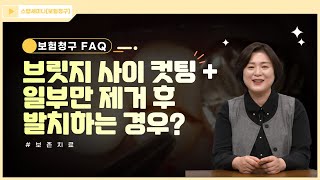 [보험청구 FAQ] 13.브릿지 사이 컷팅, 일부 제거 후 발치하는 경우 청구는?