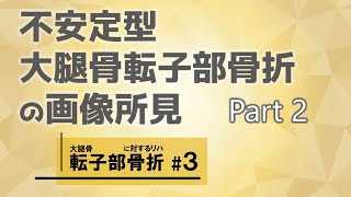 1. 基礎知識編　不安定型大腿骨転子部骨折の画像所見 Part2【大腿骨転子部骨折に対するリハビリテーション #3】