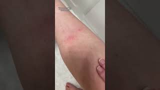 A Hair Dryer Can Help Your Bug Bite