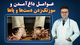 عوامل داغ آمدن و سوزنگ زدن دست ها و پاها| داکتر قیس نیکزاد