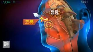 유봄성형외과 이정수 원장님 -  kbs뉴스광장 셀프성형기구