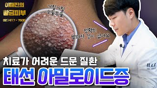 태선아밀로이드 염증성 피부질환 어떻게 방지해야하나 / 연세에이앤비 피부과 이해진원장