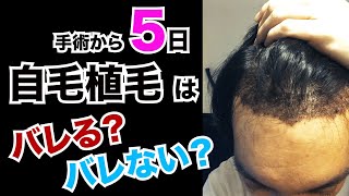 【手術から5日】自毛植毛手術は、バレるのかバレないのか？