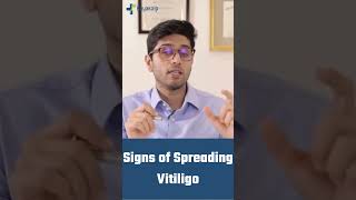 Signs of Spreading Vitiligo | Kayakalp Global #shorts #vitiligo #safeddaag