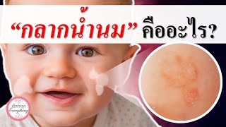 อาการทารก : กลากน้ำนมคืออะไร? | เกลื้อนน้ำนม | เด็กทารก Everything