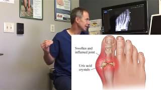 Gout – Symptoms and Treatment Options Part 1