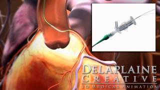 AV-8 VSI Guideliner Catheter 3D Medical Animation with pip.mp4