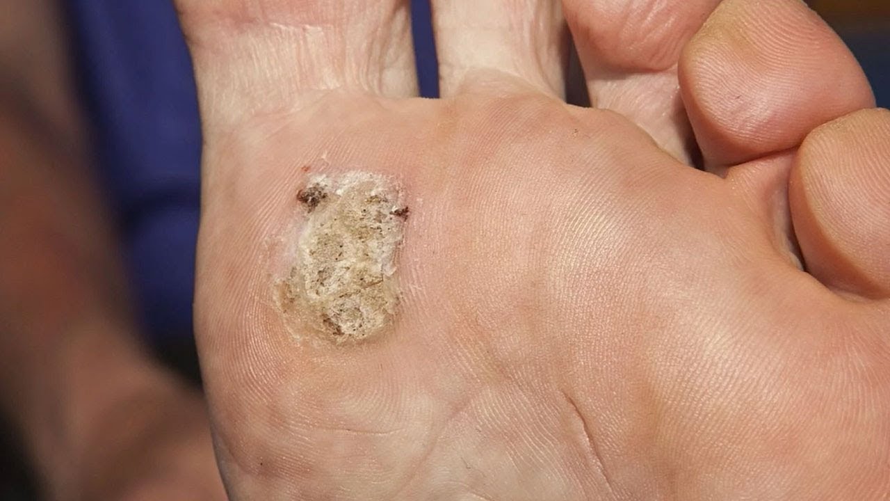 Medical Doctors Discuss Plantar Wart Removal - YouTube