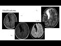 secuencias rm útiles en neuroradiología