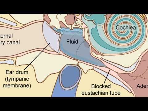 How to Treat Fluid in the Ear | Ear Problems How to Treat Fluid in the Ear | Ear Problems