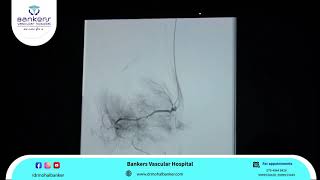 What is  genicular artery embolization \u0026 how to do it?