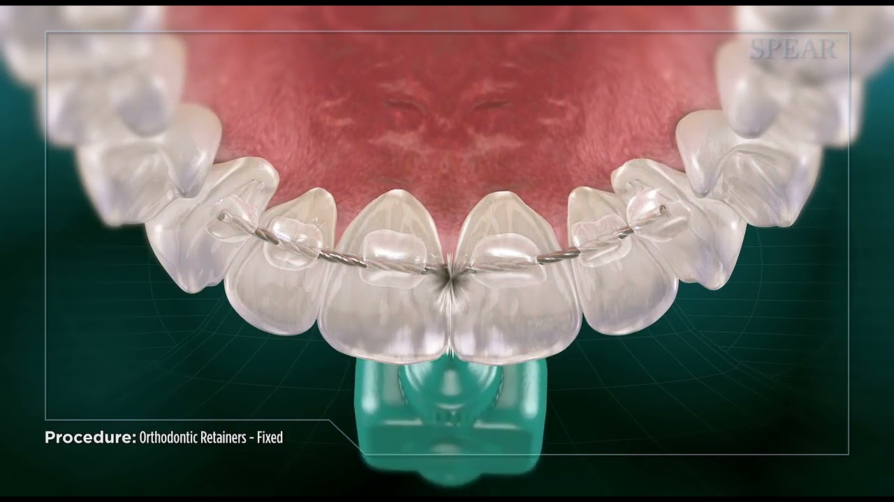 Orthodontic Retainers- Fixed - YouTube