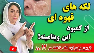 درمان قطعی لکه‌ های قهوه ای و لکه های پیری پوست صورت و بدن یکبار برای همیشه!