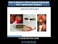 Foreign Bodies in the GI Tract: EndoCollab's Techniques for Safe Removal