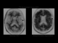 Multimodality Review of Amyloid-related Diseases of the Central Nervous System