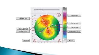 Corneal Topography   PENTACAM (Arabic Language)