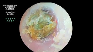 采耳哥-Cleaning of ear canal and moldy eardrum, earwax, and fungal dry patches｜663