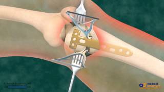 High Tibial Osteotomy (HTO) for Bow Leg Correction