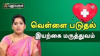 வெள்ளை படுதல் இயற்கை மருத்துவம் | Doctor On Call | PuthuyugamTV