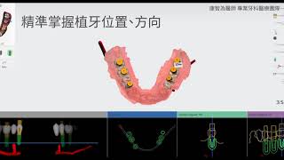 數位植牙｜為什麼有人植牙速度這麼快？多虧數位植牙讓手術變快了！