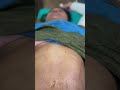 tummy liposuction with vaser ultrasonic liposuction before and after rejuvena cosmo care