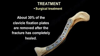 Clavicle fracture fixation , a case  presentation with the bone almost piercing the skin.