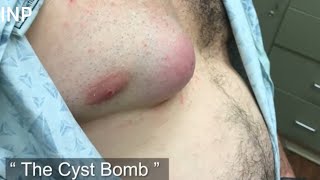 WHAT IS THAT! The Cyst Bomb | Drainage of an infected cyst