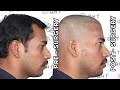 hair transplant in lakhimpur kheri best results u0026 cost of hair transplant in lakhimpur kheri