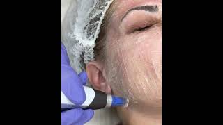 #Dermapen και #Nanopeeling για λείο και λαμπερό δέρμα