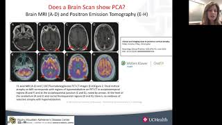 Posterior Cortical Atrophy Lecture with neurologist Victoria Pelak,of the University of Colorado