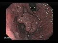 Endoscopy of Large Gastric Varices