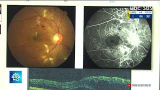당뇨보다 무서운 합병증  당뇨 망막병증 20201108