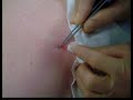 Skin surgery - shave excision 2