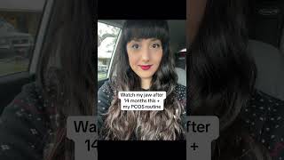 Watch my jaw change 1 month vs 14 months #pcosweightloss #magnesium #transformation