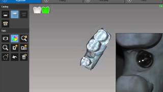 CS 3500 2016  - Implant 1 Upper