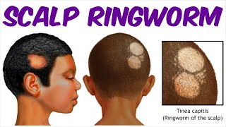 Scalp Ringworm (-A Tinea capitis Infection)