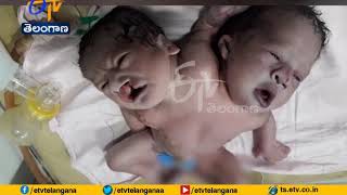 Woman Gives Birth | to Baby with Two Heads , Three Hands | in Madhya Pradesh's Vidisha