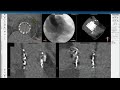 3Mensio CT Pre-case Planning: Redo-TAVR with Prior Sapien 3 (1 of 2)