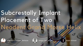 Implant placement of 2 GM Grand Morse Helix to restore two molars.