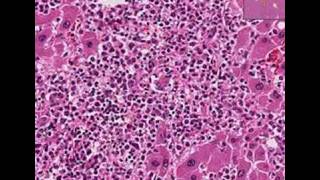 Histopathology Liver--Acute myeloid leukemia