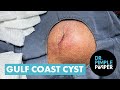 Dr Pimple Popper Opens The 'Gulf Coast' Cyst