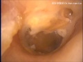 中耳炎 聽力障礙 耳鳴 眩暈 耳膜塌陷 bilateral eardrum retraction com