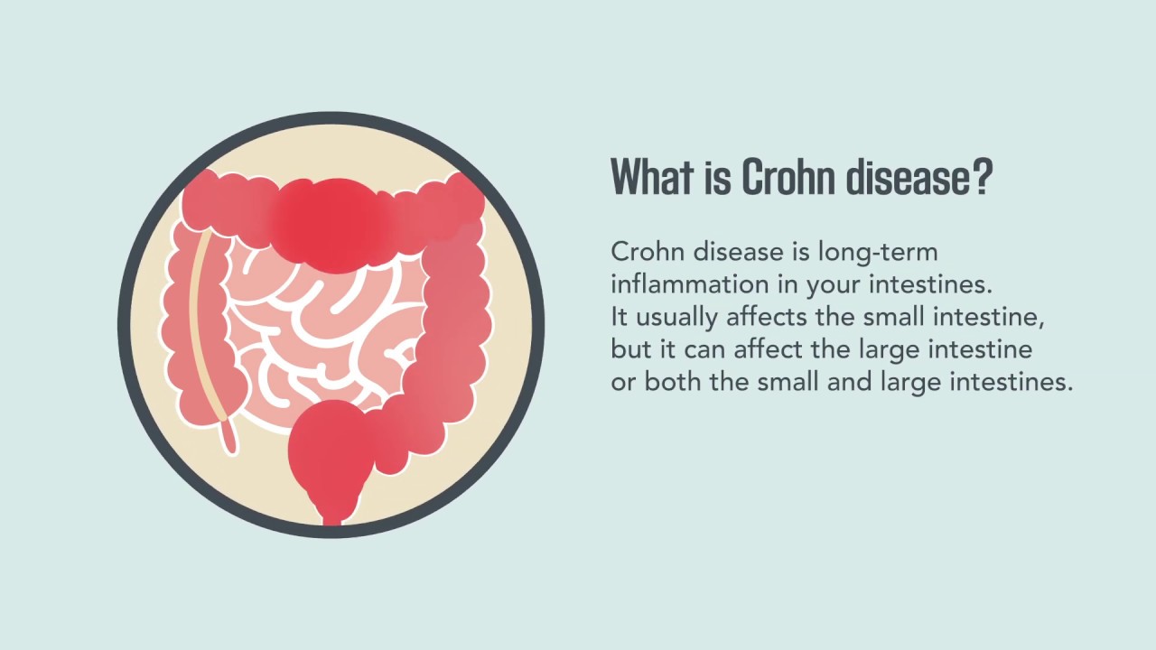 Crohn Disease: Signs, Symptoms, Causes, And Treatment | Merck Manual ...