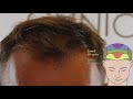 hair transplant fue 1200 grafts result before after hairhungary clinic budapest