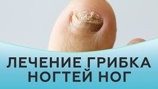 Грибок ногтей. Лечение грибка ногтей. Грибок на ногтях ног